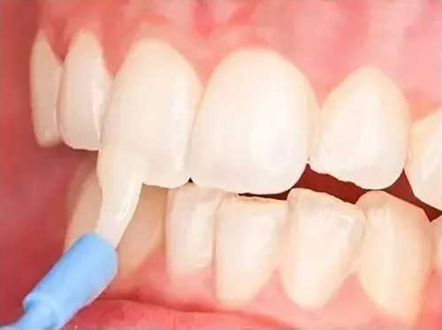 piciture of using fluoride coating