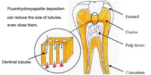 The picuture shows the function of sodium monoflurophophaste cure tooth sensitivity.