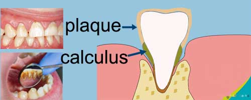 Picture of plagque and calculus on teeth