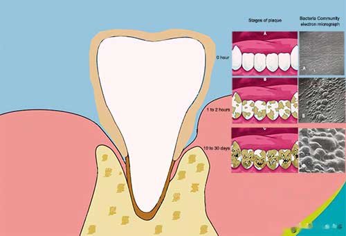 the stages of plaque forming