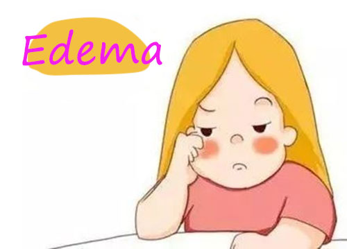 Picture of edema symptom