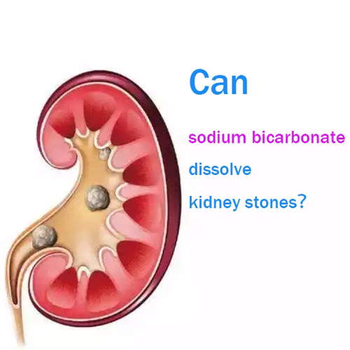Can Sodium Bicarbonate Dissolve Kidney Stones?