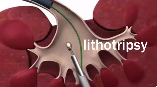 lithotripsy